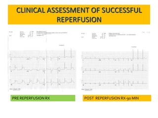 PRE REPERFUSION RX POST REPERFUSION RX-90 MIN
CLINICAL ASSESSMENT OF SUCCESSFUL
REPERFUSION
 