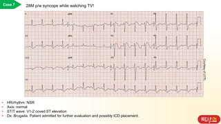 Case 7 28M p/w syncope while watching TV!
• HR/rhythm: NSR
• Axis: normal
• ST/T wave: V1-2 coved ST elevation
• Dx: Brugada. Patient admitted for further evaluation and possibly ICD placement.
CourtesyofLITFL
 