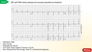 Case 8 50F with PMH kidney disease p/w syncope preceded by headache
• HR/rhythm: NSR
• Axis: normal
• Prolonged QT interval
• ST/T wave: Deep negative T-waves in V2-V4
• DDx: Subarachnoid hemorrhage. Head CT confirmed the diagnosis.
CourtesyofLITFL
 