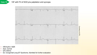 15F with FH of SCD p/w palpitation and syncope.Case 10
• HR/rhythm: NSR
• Axis: normal
• QTc 550ms
• Dx: Congenital Long QT Syndrome. Admitted for further evaluation.
CourtesyofLITFL
 