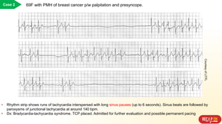 • Rhythm strip shows runs of tachycardia interspersed with long sinus pauses (up to 6 seconds). Sinus beats are followed by
paroxysms of junctional tachycardia at around 140 bpm.
• Dx: Bradycardia-tachycardia syndrome. TCP placed. Admitted for further evaluation and possible permanent pacing
Case 2 69F with PMH of breast cancer p/w palpitation and presyncope.
CourtesyofLITFL
 