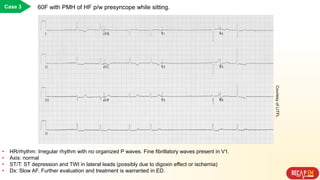 Case 3 60F with PMH of HF p/w presyncope while sitting.
• HR/rhythm: Irregular rhythm with no organized P waves. Fine fibrillatory waves present in V1.
• Axis: normal
• ST/T: ST depression and TWI in lateral leads (possibly due to digoxin effect or ischemia)
• Dx: Slow AF. Further evaluation and treatment is warranted in ED.
CourtesyofLITFL
 