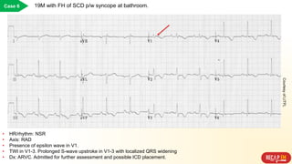 Case 6 19M with FH of SCD p/w syncope at bathroom.
• HR/rhythm: NSR
• Axis: RAD
• Presence of epsilon wave in V1.
• TWI in V1-3. Prolonged S-wave upstroke in V1-3 with localized QRS widening
• Dx: ARVC. Admitted for further assessment and possible ICD placement.
CourtesyofLITFL
 