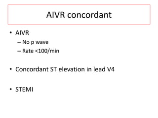 AIVR concordant
• AIVR
– No p wave
– Rate <100/min
• Concordant ST elevation in lead V4
• STEMI
 
