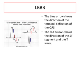 LBBB
• The blue arrow shows
the direction of the
terminal deflection of
the QRS
• The red arrows shows
the direction of the ST
segment and the T
wave.
 