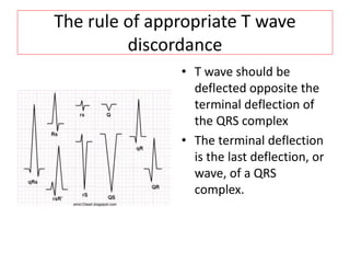 The rule of appropriate T wave
discordance
• T wave should be
deflected opposite the
terminal deflection of
the QRS complex
• The terminal deflection
is the last deflection, or
wave, of a QRS
complex.
 