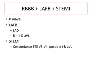 RBBB + LAFB + STEMI
• P wave
• LAFB
– LAD
– R in I & aVL
• STEMI
– Concordance STE V3-V4, possible I & aVL
 