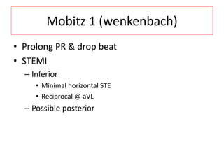 Mobitz 1 (wenkenbach)
• Prolong PR & drop beat
• STEMI
– Inferior
• Minimal horizontal STE
• Reciprocal @ aVL
– Possible posterior
 