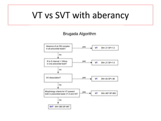 VT vs SVT with aberancy
 