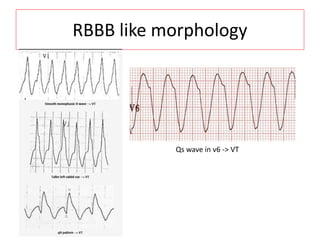 RBBB like morphology
Qs wave in v6 -> VT
 