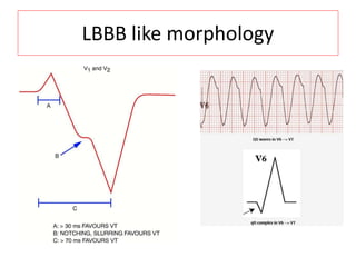LBBB like morphology
 