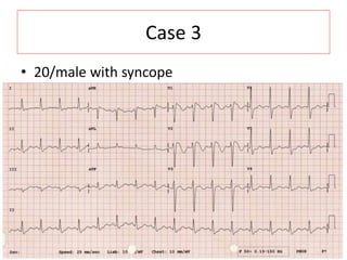 Case 3
• 20/male with syncope
 