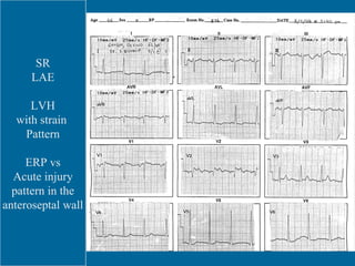 SR LAE LVH with strain  Pattern ERP vs Acute injury pattern in the anteroseptal wall 