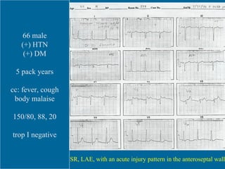 SR, LAH, LAE, IVCD, LVH, lateral wall ischemia and/or strain. NSSTTWC, inferior wall. ERP vs.  acute injury, anteroseptal wall. 66 male (+) HTN (+) DM 5 pack years cc: fever, cough body malaise 150/80, 88, 20 trop I negative SR, LAE, with an acute injury pattern in the anteroseptal wall 