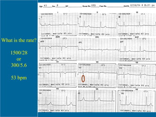 What is the rate? 1500/28 or 300/5.6 53 bpm 