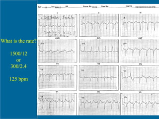What is the rate? 1500/12 or 300/2.4 125 bpm 