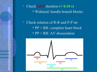 Check  QRS  duration  (< 0.10 s ) Widened: bundle branch blocks Check relation of R-R and P-P int PP < RR: complete heart block PP > RR: AV dissociation 