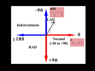 Normal (-30 to +90) RAD Indeterminate LAD 