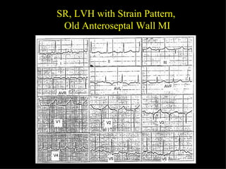 SR, LVH with Strain Pattern,  Old Anteroseptal Wall MI 