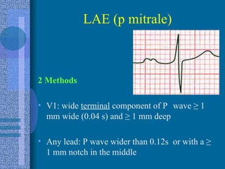 LAE (p mitrale) 2 Methods V1: wide  terminal  component of P  wave  ≥  1 mm wide (0.04 s) and  ≥  1 mm deep Any lead: P wave wider than 0.12s  or with a  ≥  1 mm notch in the middle 
