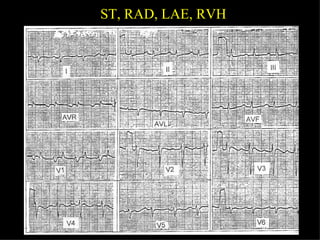 ST, RAD, LAE, RVH 