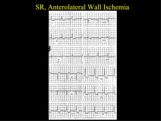 SR, Anterolateral Wall Ischemia 