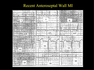 Recent Anteroseptal Wall MI 