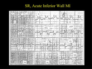 SR, Acute Inferior Wall MI 