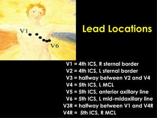 V1 = 4th ICS, R sternal border V2 = 4th ICS, L sternal border V3 = halfway between V2 and V4 V4 = 5th ICS, L MCL V5 = 5th ICS, anterior axillary line V6 = 5th ICS, L mid-midaxillary line V3R = halfway between V1 and V4R V4R =  5th ICS, R MCL  Lead Locations 