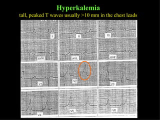 Hyperkalemia tall, peaked T waves usually >10 mm in the chest leads 