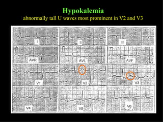 Hypokalemia abnormally tall U waves most prominent in V2 and V3 