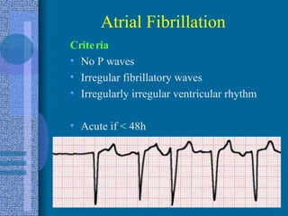 Atrial Fibrillation Criteria No P waves Irregular fibrillatory waves Irregularly irregular ventricular rhythm Acute if < 48h 