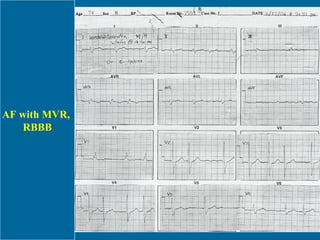 AF with MVR,  RBBB 