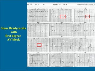 Sinus Bradycardia with first degree  AV block 