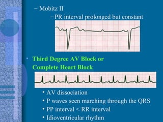 Mobitz II PR interval prolonged but constant Third Degree AV Block or  Complete Heart Block AV dissociation P waves seen marching through the QRS PP interval < RR interval Idioventricular rhythm 