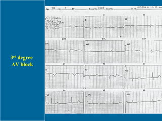 3 rd  degree  AV block 