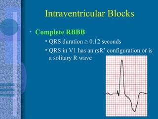 Intraventricular Blocks Complete RBBB QRS duration  ≥  0.12 seconds QRS in V1 has an rsR’ configuration or is a solitary R wave 