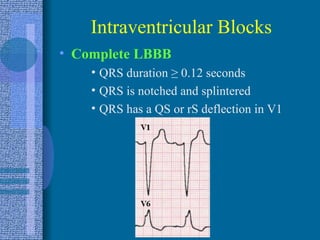Intraventricular Blocks Complete LBBB QRS duration  ≥  0.12 seconds QRS is notched and splintered QRS has a QS or rS deflection in V1 