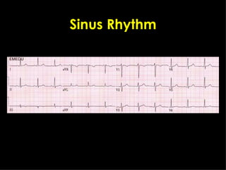 Sinus Rhythm 
