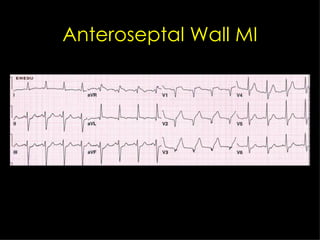 Anteroseptal Wall MI 