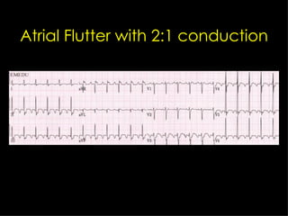 Atrial Flutter with 2:1 conduction 