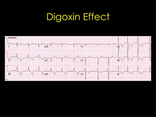 Digoxin Effect 