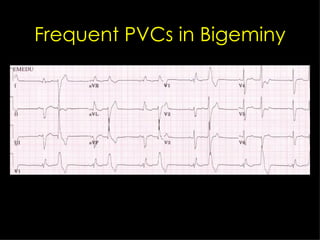Frequent PVCs in Bigeminy 