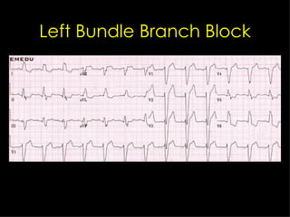 Left Bundle Branch Block 