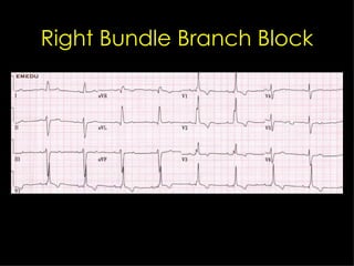 Right Bundle Branch Block 