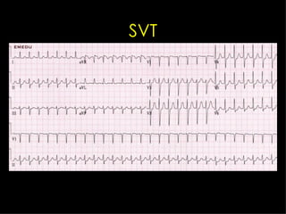 SVT 