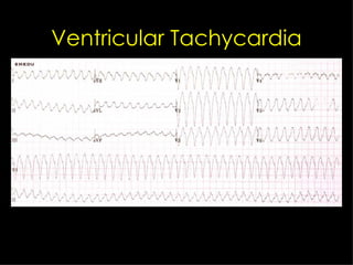 Ventricular Tachycardia 