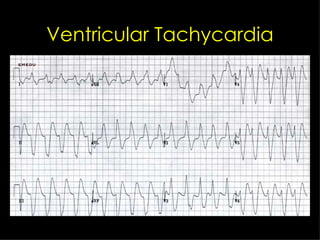 Ventricular Tachycardia 