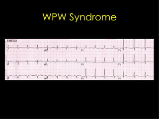 WPW Syndrome 