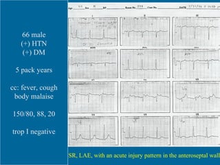 SR, LAH, LAE, IVCD, LVH, lateral wall ischemia and/or strain. NSSTTWC, inferior wall. ERP vs.  acute injury, anteroseptal ...